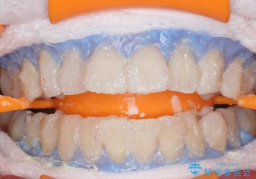 PMTC+ホワイトニングエクセレントコースで白く輝く歯に。の治療中