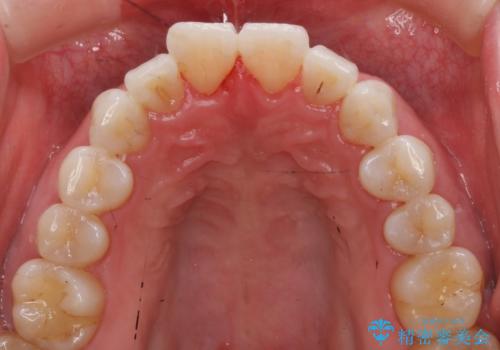 PMTC+ホワイトニングエクセレントコースで白く輝く歯に。の治療後