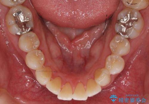 PMTC+ホワイトニングエクセレントコースで白く輝く歯に。の治療後