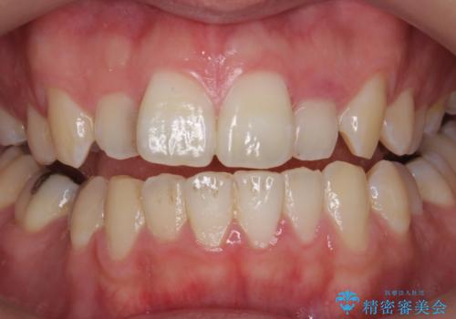 PMTC30分コースとホワイトニングエクセレントコースを併用して白い歯に。の治療前