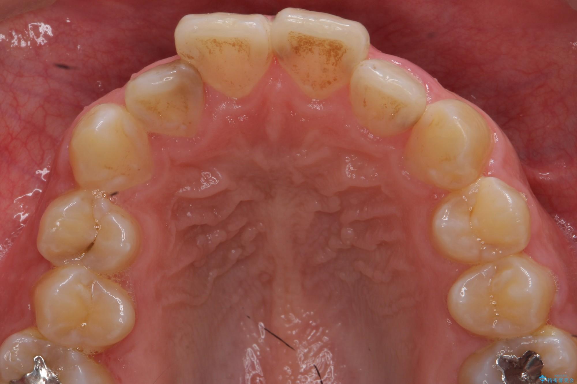 PMTC30分コースとホワイトニングエクセレントコースを併用して白い歯に。の治療前（顔貌）