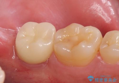 インプラント治療　虫歯で失った歯の補綴の治療後