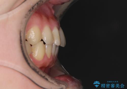 前歯のすきっぱ　マウスピース矯正～ASOアライナー～の治療前