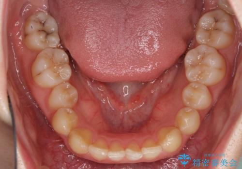 前歯のすきっぱ　マウスピース矯正～ASOアライナー～の治療前