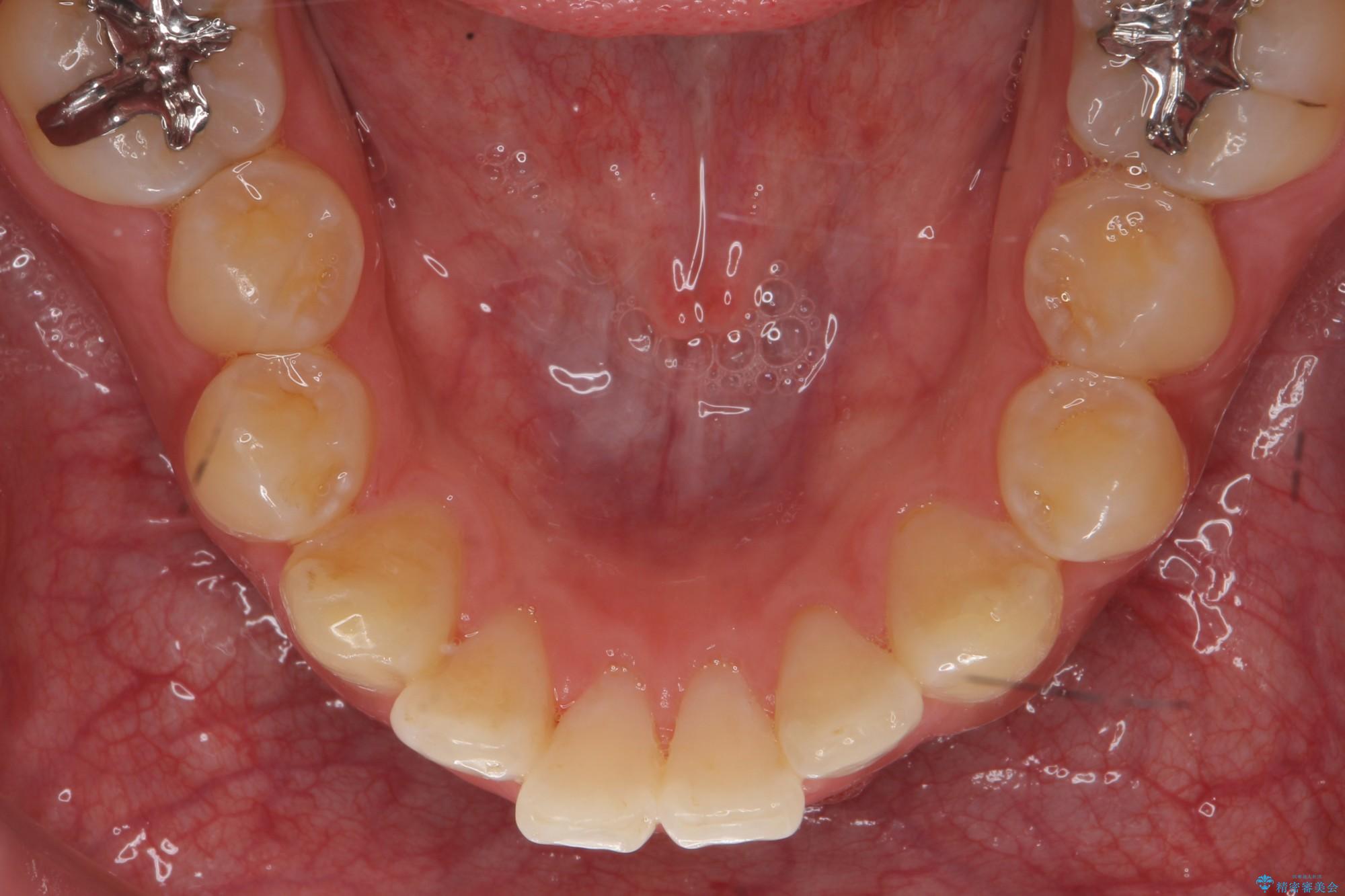 PMTC30分コースとホワイトニングエクセレントコースを併用して白い歯に。の治療後（顔貌）