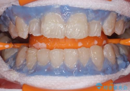PMTC30分コースとホワイトニングエクセレントコースを併用して白い歯に。の治療中