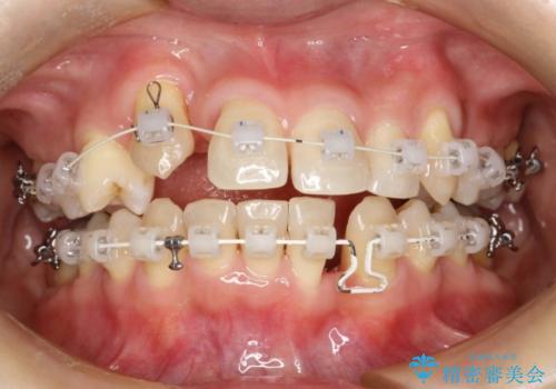 重度歯周炎の歯を抜歯してワイヤー矯正を　変則的なかみ合わせで仕上げるの治療中