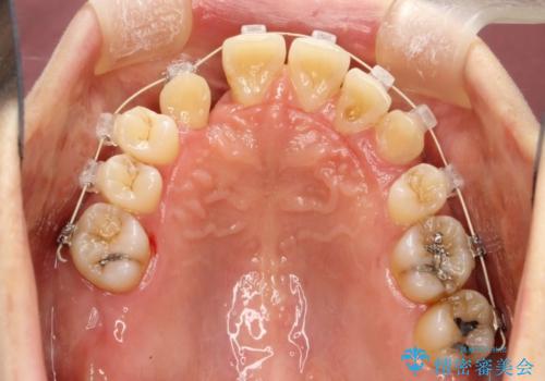 重度歯周炎の歯を抜歯してワイヤー矯正を　変則的なかみ合わせで仕上げるの治療中