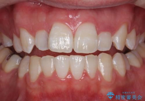 PMTC30分コースとホワイトニングエクセレントコースを併用して白い歯に。の治療後