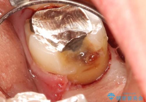 歯ぐきの深い位置まで虫歯が　歯周外科→被せもの による奥歯の治療の治療中