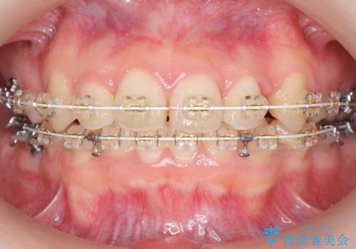 八重歯　奥歯のすれ違い　ワイヤー矯正でしっかり治療の治療中
