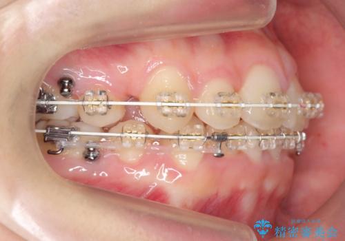 八重歯　奥歯のすれ違い　ワイヤー矯正でしっかり治療の治療中