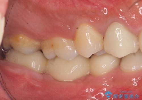 オールセラミッククラウン・歯冠長延長術　抜歯後の補綴の治療後