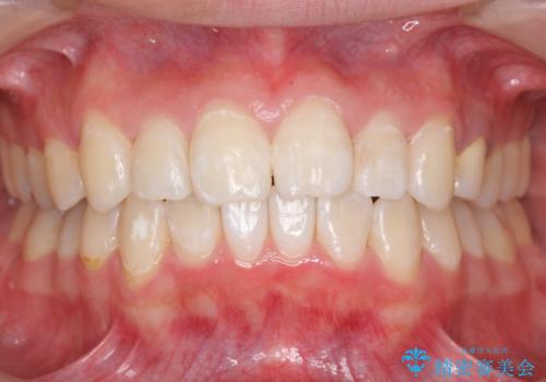 20代女性　前歯のねじれ・出っ歯　インビザラインで奥歯を下げて抜かずに治療の治療後