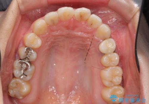 20代女性　前歯のねじれ・出っ歯　インビザラインで奥歯を下げて抜かずに治療の治療後
