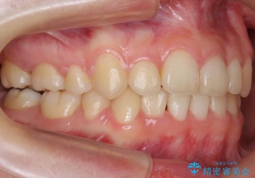 八重歯　奥歯のすれ違い　ワイヤー矯正でしっかり治療の治療後