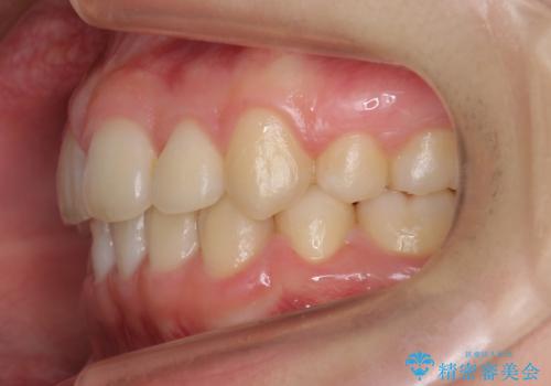 八重歯　奥歯のすれ違い　ワイヤー矯正でしっかり治療の治療後