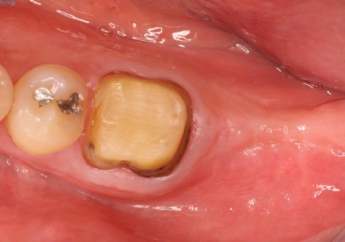 インプラント周囲の歯肉移植～最終的なセラミックを入れるまでの治療前