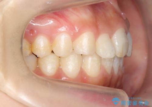 30代女性　抜かない矯正　出っ歯　低位歯を並べましたの治療後