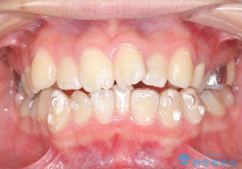 20代女性　前歯のねじれ・出っ歯　インビザラインで奥歯を下げて抜かずに治療の治療中