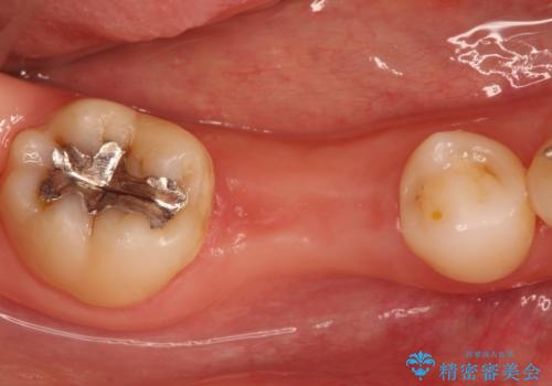 しっかり噛める奥歯。インプラント治療の治療前