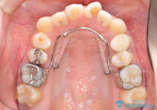 20代女性　前歯のねじれ・出っ歯　インビザラインで奥歯を下げて抜かずに治療の治療中