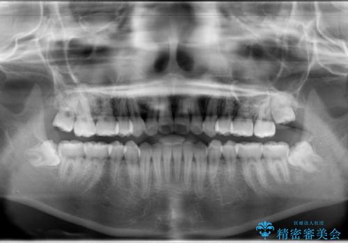 王道・従来のワイヤー矯正　表の装置で手早くきれいな歯並びをの治療後