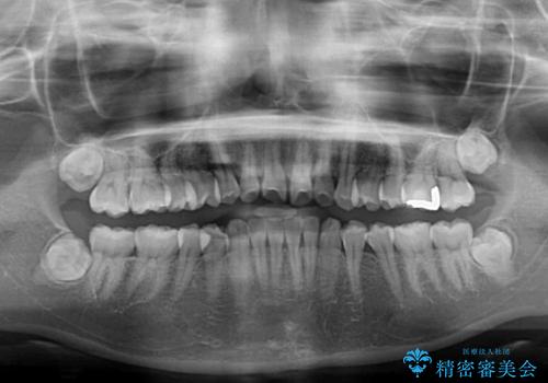 前歯のデコボコと出っ歯を治したい　インビザラインによる非抜歯矯正治療の治療前