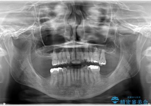 重度歯周炎の歯を抜歯してワイヤー矯正を　変則的なかみ合わせで仕上げるの治療後
