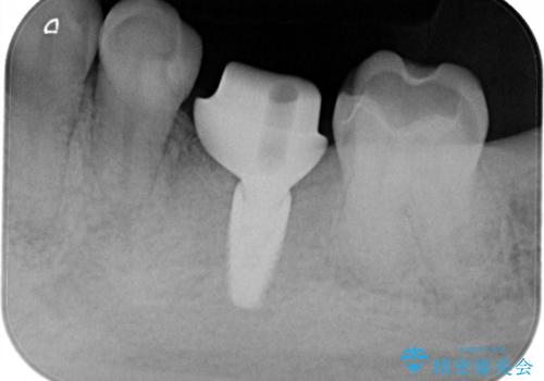 左下奥歯　折れて抜歯　インプラントへの治療後