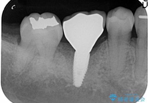しっかり噛める奥歯。インプラント治療の治療後