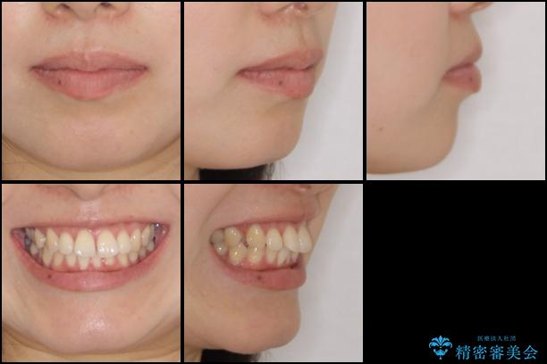 前歯のデコボコと出っ歯を治したい　インビザラインによる非抜歯矯正治療の治療前（顔貌）