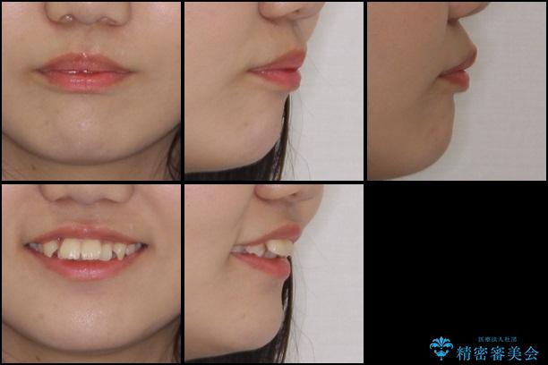 前歯の出っ歯とでこぼこ　目立たないワイヤーで抜歯矯正の治療前（顔貌）