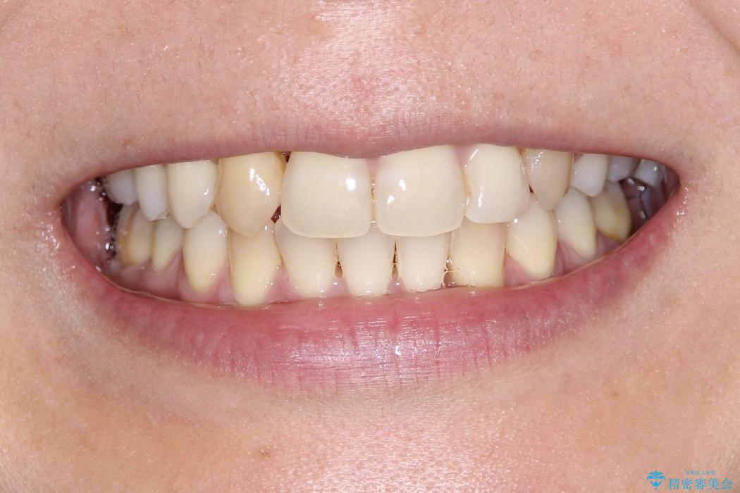 重度歯周炎の歯を抜歯してワイヤー矯正を　変則的なかみ合わせで仕上げるの治療後（顔貌）