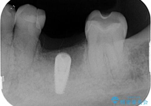 左下奥歯　折れて抜歯　インプラントへの治療前