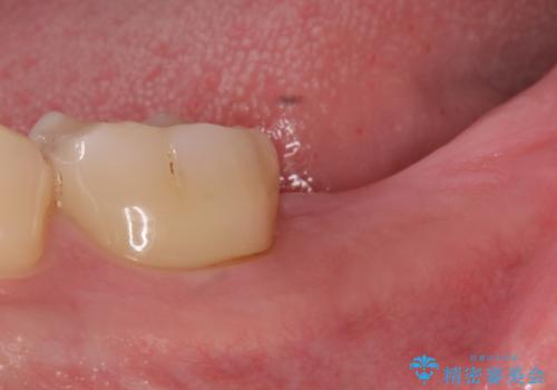 [30代男性] インプラント　失った歯の治療の治療前