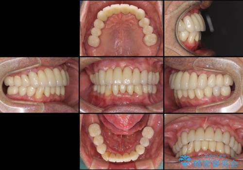 ボロボロの歯を何とかしたい　総合歯科治療による全顎治療の治療後