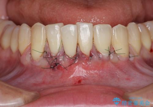 [歯茎の再生]  歯肉移植3年経過後の状態の治療前
