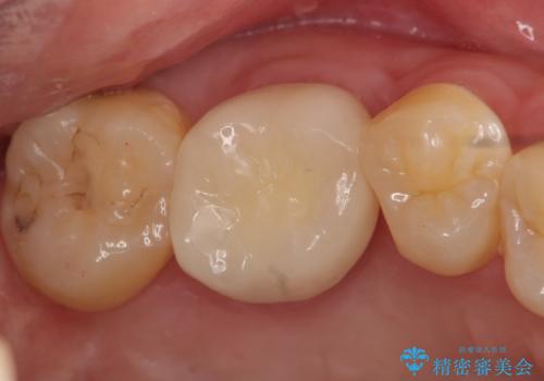 オールセラミッククラウン　歯茎より深い虫歯(縁下カリエス)の治療の症例 治療後