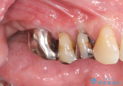 重度に吸収した歯槽骨を再建　インプラント咬合機能回復の症例 治療前