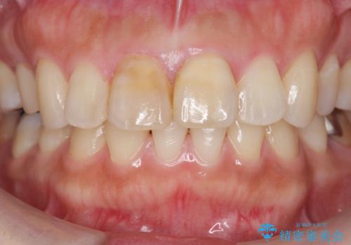前歯の変色　見える前歯の審美改善セラミック治療の治療前