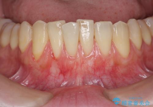 [歯茎の再生]  歯肉移植3年経過後の状態の症例 治療後