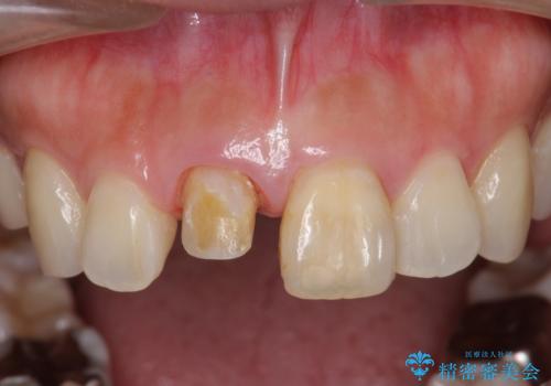 前歯の変色　見える前歯の審美改善セラミック治療の治療中