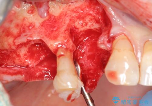 重度に吸収した歯槽骨を再建　インプラント咬合機能回復