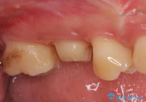 オールセラミッククラウン　歯茎より深い虫歯(縁下カリエス)の治療の治療中