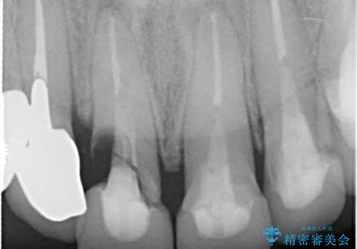 前歯のかぶせものの下に巨大な虫歯が　ぎりぎり抜歯をまぬがれるにはの症例 治療前