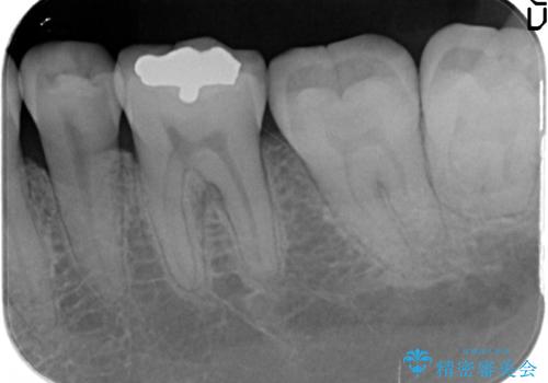 セラミックインレー　銀歯を白くの治療前