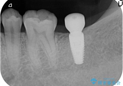 [30代男性] インプラント　失った歯の治療の治療後