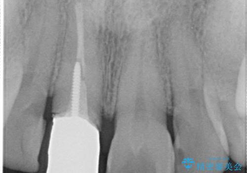 金属製の前歯をメタルフリーにしたい　単独前歯のセラミック処理の治療前