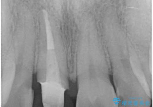 金属製の前歯をメタルフリーにしたい　単独前歯のセラミック処理の治療中
